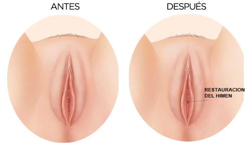 Reconstruction del himen CDMX